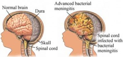 Gambar radang selaput otak pada anak (houseplanswithphotos.xyz)
